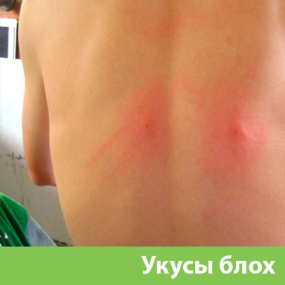Укусы блох в Раменском