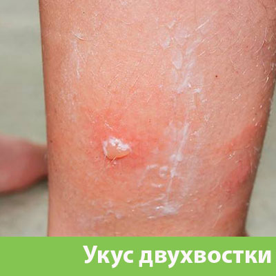 Укус двухвостки в Раменском