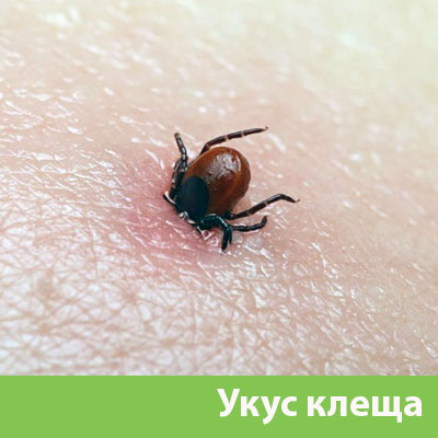 Укус клеща в Раменском