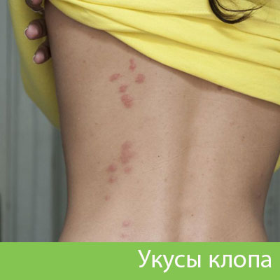 Профессиональное уничтожение клопов в Раменском